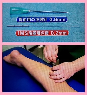 IMS治療（筋肉内刺激法）