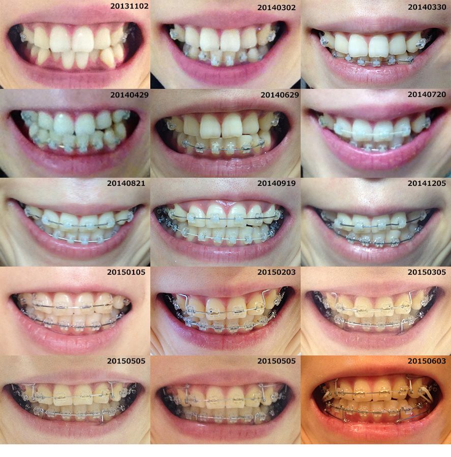 大人の歯列矯正ブログ歯列矯正 歯の写真一覧